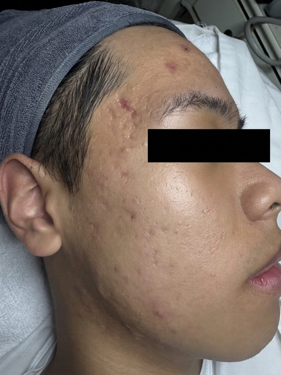 Cystic Acne Recovery — in progress