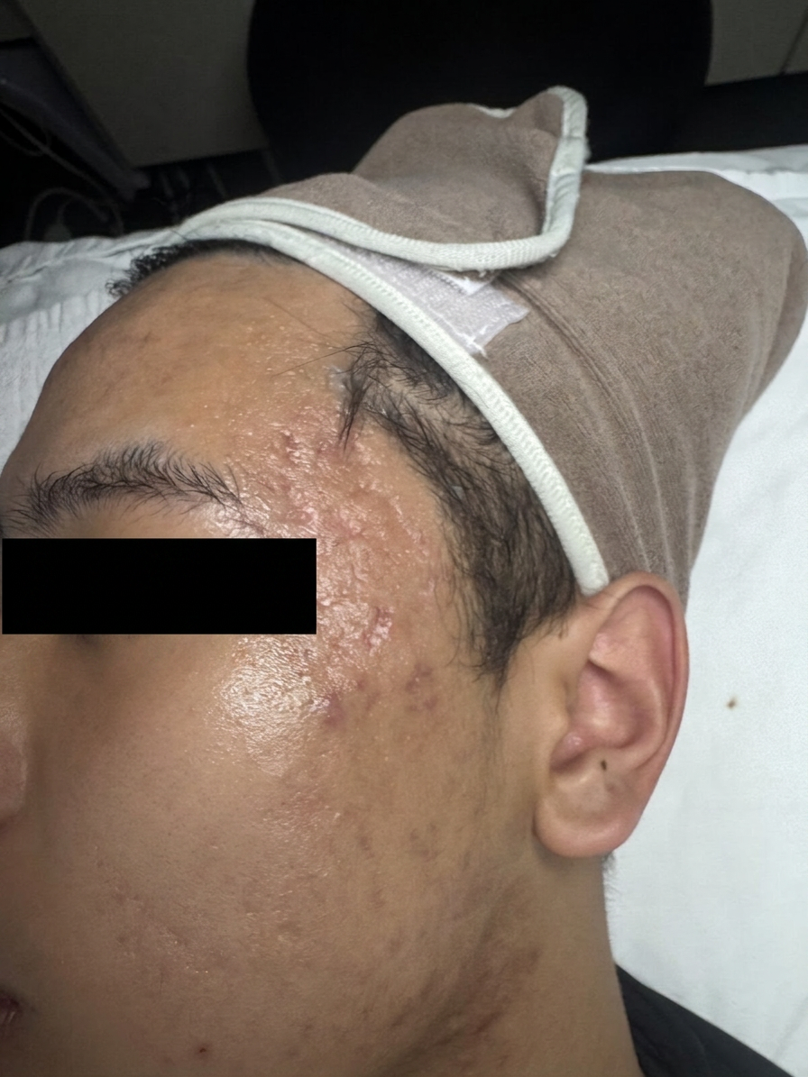 Cystic Acne Recovery — before
