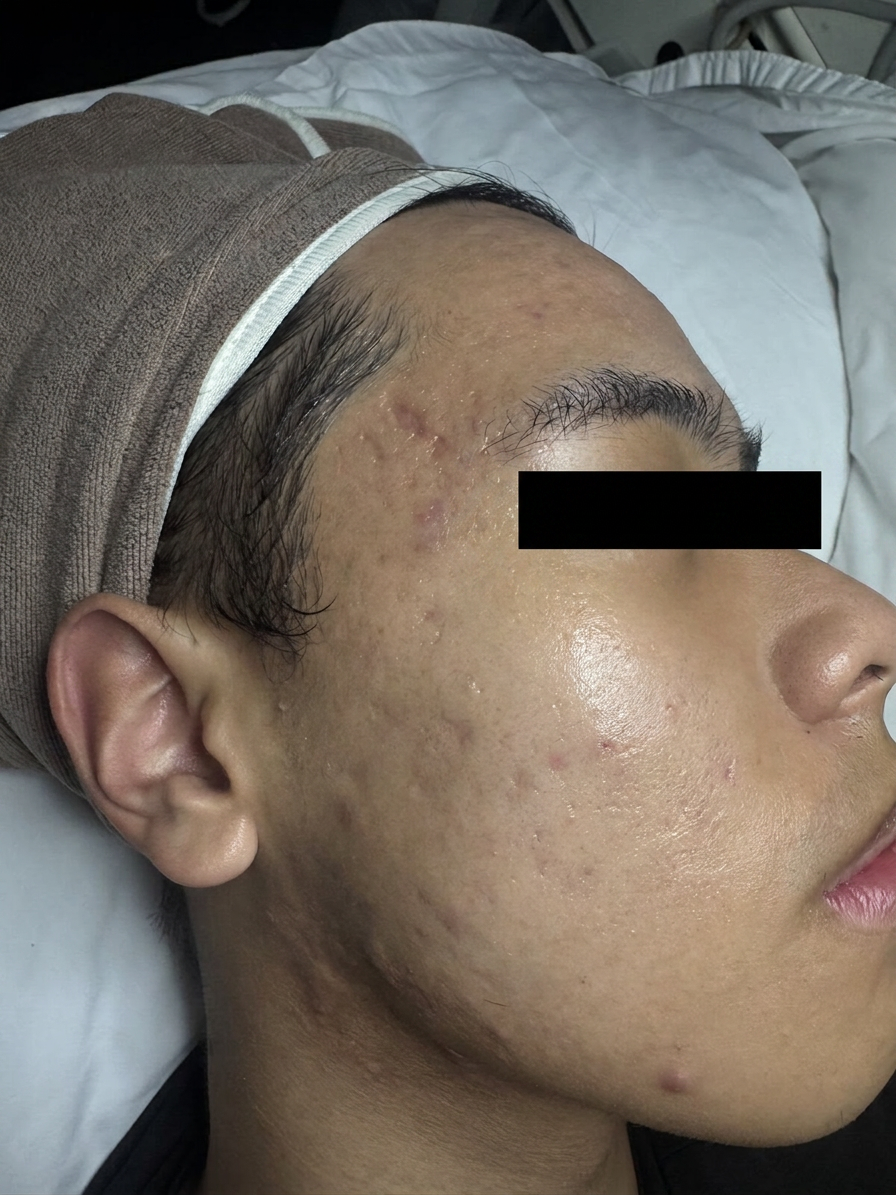 Cystic Acne Recovery — after